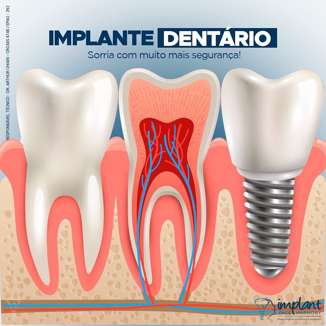 Implantes